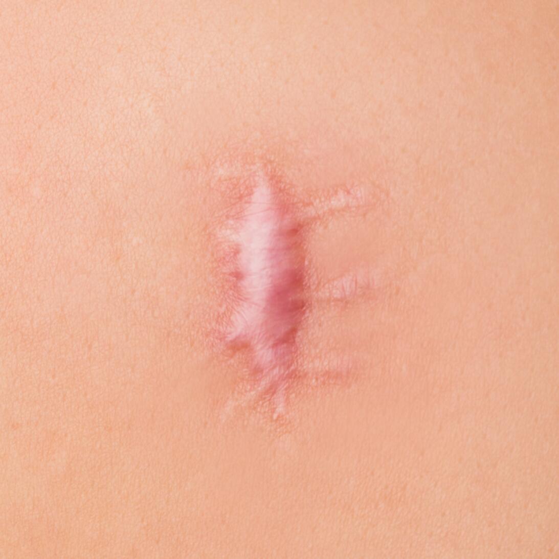 cicatriz hipertrófica